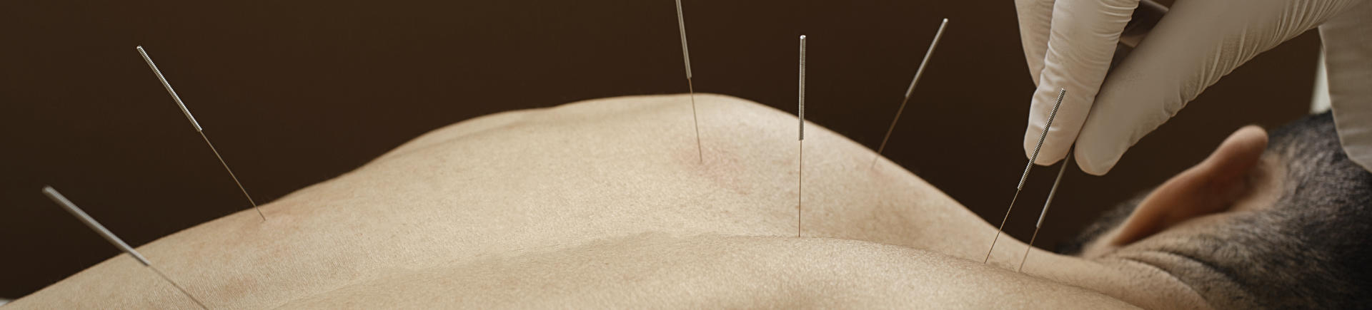 man undergoing acupuncture